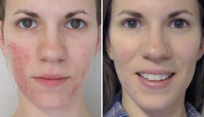 Ivermectin Cream