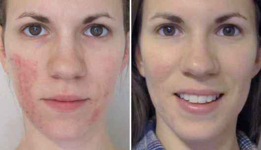 Ivermectin Cream