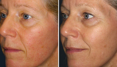 Ivermectin Cream