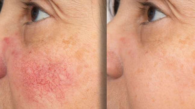 Ivermectin Cream