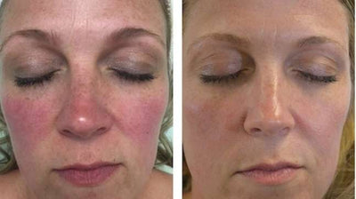 Ivermectin Cream