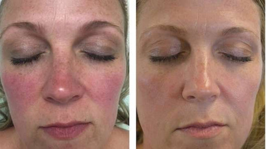 Ivermectin Cream